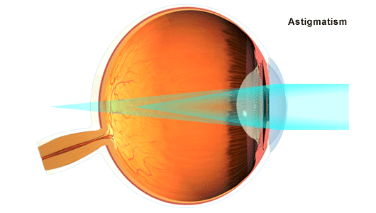 astigmatism