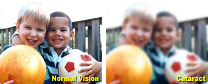 Normal vision vs. Cataract vision, which is much blurrier