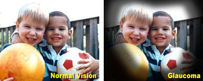 Normal vision vs. Glaucoma vision, which is characterized by darkness at the edges of vision