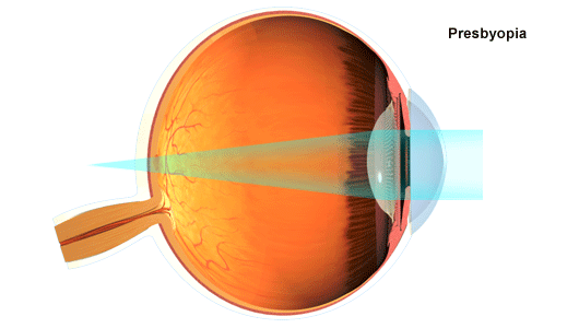 tweeten boise ophthalmology