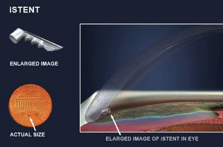 A graphic labeled iSTENT comparing the size of the medical device to be no bigger than a penny, and showing a cross-section image of a cornea with the device installed.